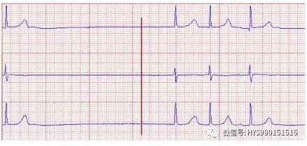 心电监护怎么看图【PLUS版】心电图危急值识别及紧急处理，值得每个医生收藏！！！_https://www.jmylbn.com_新闻资讯_第19张
