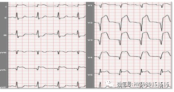心电监护怎么看图【PLUS版】心电图危急值识别及紧急处理，值得每个医生收藏！！！_https://www.jmylbn.com_新闻资讯_第6张
