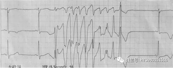 心电监护怎么看图【PLUS版】心电图危急值识别及紧急处理，值得每个医生收藏！！！_https://www.jmylbn.com_新闻资讯_第24张