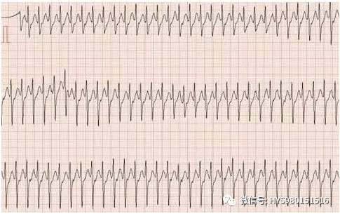心电监护怎么看图【PLUS版】心电图危急值识别及紧急处理，值得每个医生收藏！！！_https://www.jmylbn.com_新闻资讯_第11张