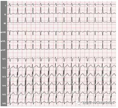 心电监护怎么看图【PLUS版】心电图危急值识别及紧急处理，值得每个医生收藏！！！_https://www.jmylbn.com_新闻资讯_第10张