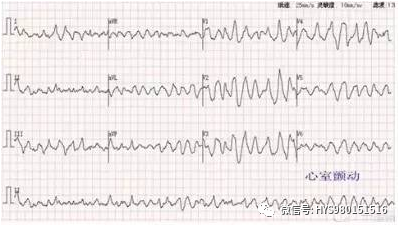 心电监护怎么看图【PLUS版】心电图危急值识别及紧急处理，值得每个医生收藏！！！_https://www.jmylbn.com_新闻资讯_第18张