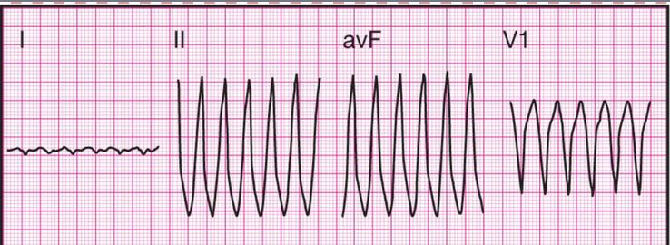 心电监护怎么看图14种异常心电图波形特点，收藏！_https://www.jmylbn.com_新闻资讯_第7张