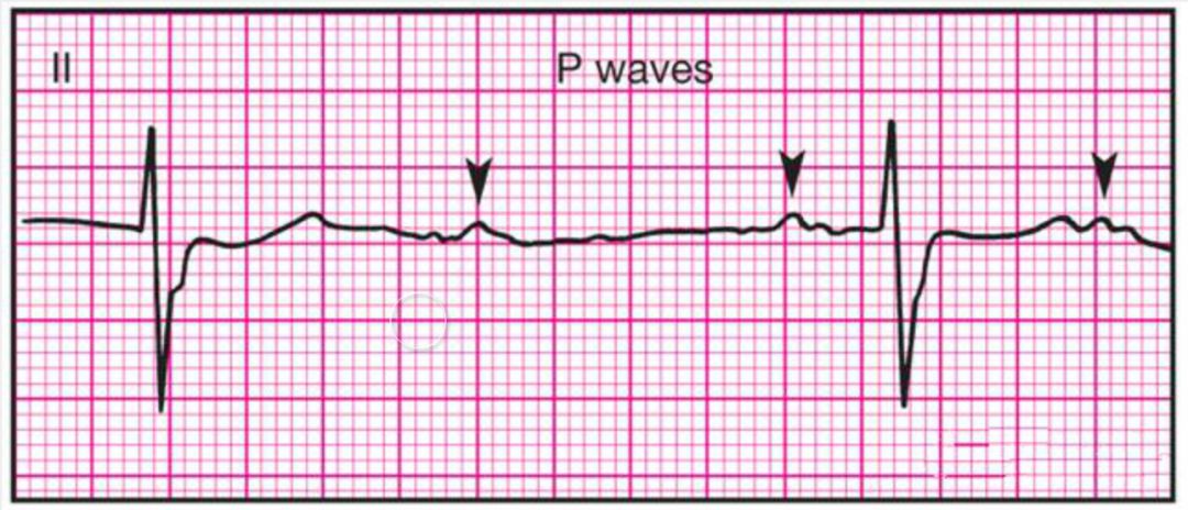 心电监护怎么看图14种异常心电图波形特点，收藏！_https://www.jmylbn.com_新闻资讯_第11张