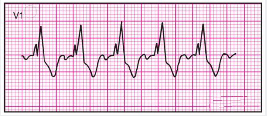 心电监护怎么看图14种异常心电图波形特点，收藏！_https://www.jmylbn.com_新闻资讯_第12张