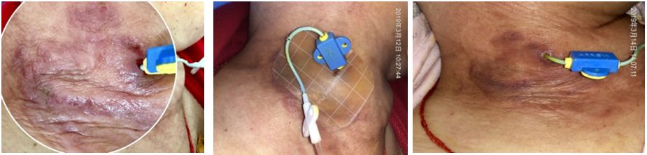 水胶体创口怎么去除创可贴的未来趋势？这个可吸收伤口污染物、促进愈合的敷料你用过吗_https://www.jmylbn.com_新闻资讯_第7张