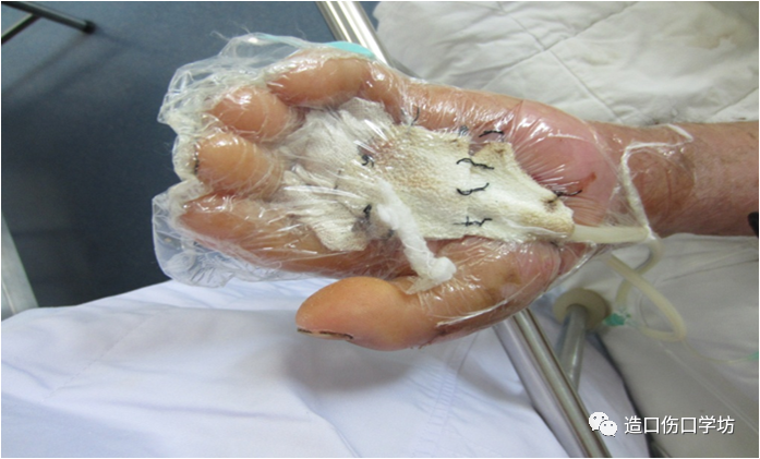 vsd敷料怎么去VSD负压治疗护理要点_https://www.jmylbn.com_新闻资讯_第6张