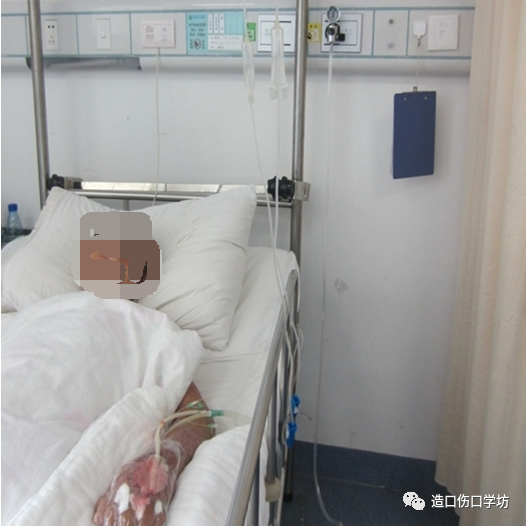 vsd敷料怎么去VSD负压治疗护理要点_https://www.jmylbn.com_新闻资讯_第3张