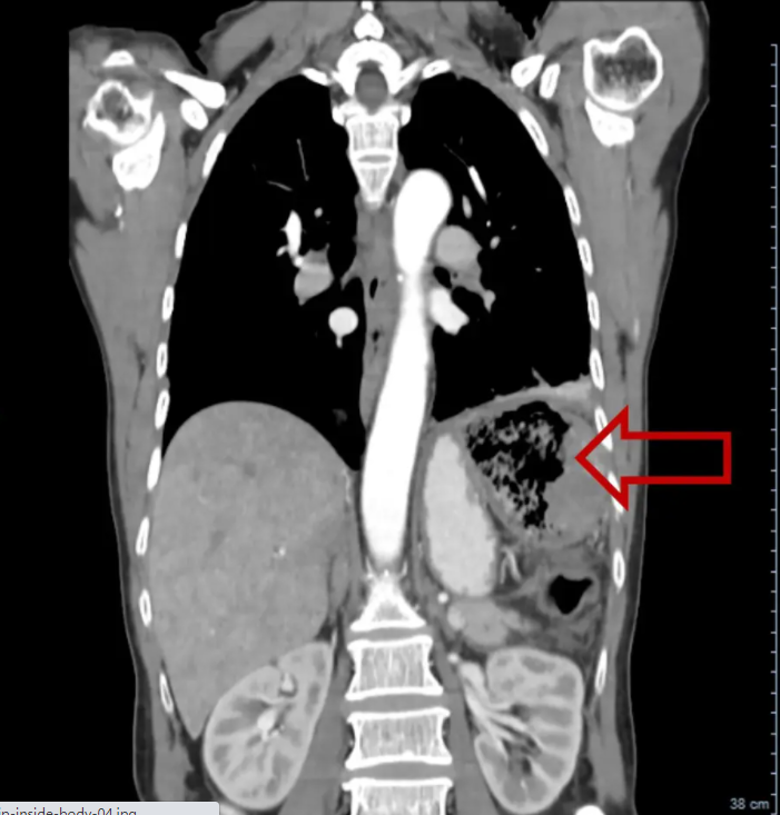 为什么医院的纱布不卖纱布在身体里20多年！女子突然发烧、腹痛、掉秤 医院一查让人咋舌_https://www.jmylbn.com_新闻资讯_第3张