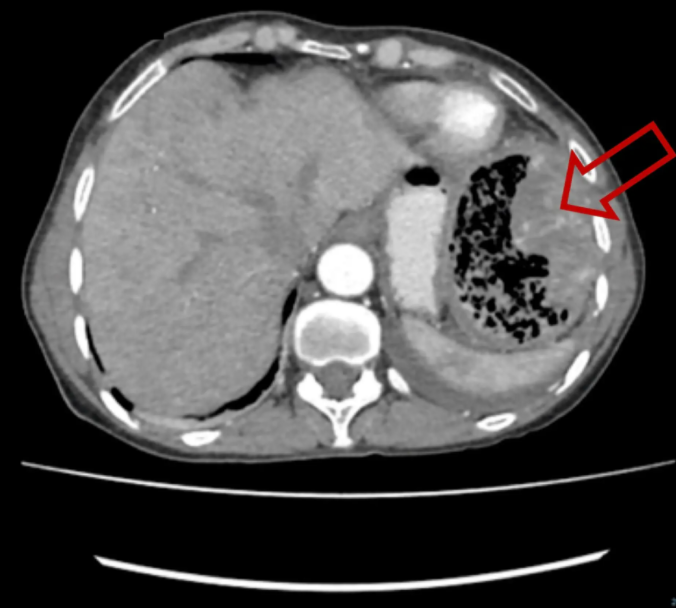 为什么医院的纱布不卖纱布在身体里20多年！女子突然发烧、腹痛、掉秤 医院一查让人咋舌_https://www.jmylbn.com_新闻资讯_第4张
