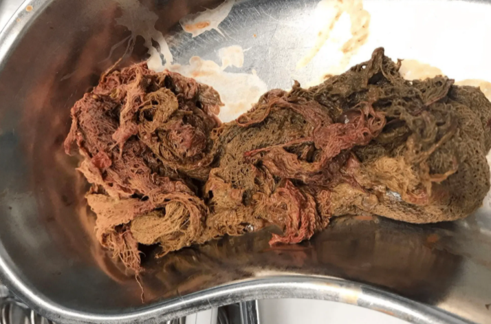 为什么医院的纱布不卖纱布在身体里20多年！女子突然发烧、腹痛、掉秤 医院一查让人咋舌_https://www.jmylbn.com_新闻资讯_第6张