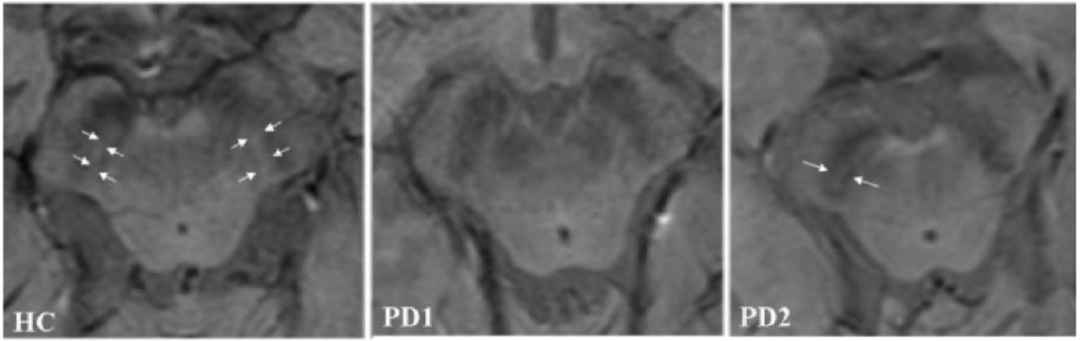 小福影像苑|磁敏感加權成像（SWI）在帕金森病中的診斷價值(圖4)