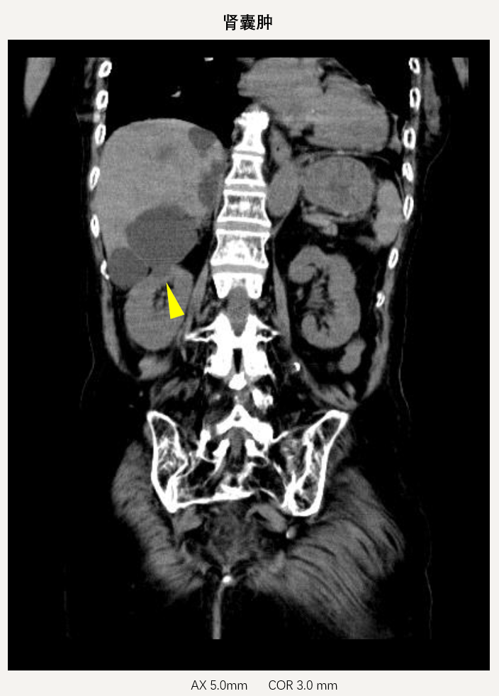 小福影像苑| 超聲、CT、MRI在腎臟占位性病變診斷中的應用價值(圖6)