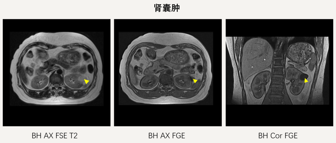 小福影像苑| 超聲、CT、MRI在腎臟占位性病變診斷中的應用價值(圖8)