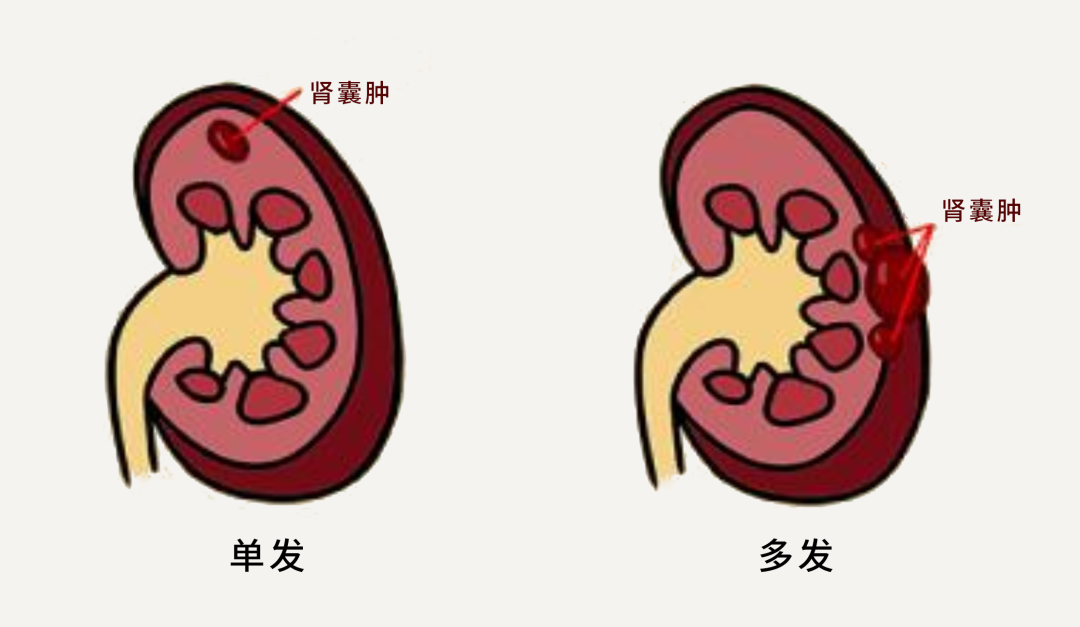 小福影像苑| 超聲、CT、MRI在腎臟占位性病變診斷中的應用價值(圖2)