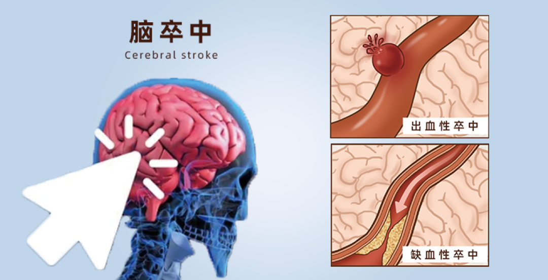 揮手卒中，預防先行——康達卡勒幅腦血管血液動力監測儀成功入駐浙江省人民醫院望江山院區(圖4)
