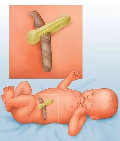 为什么剪脐带要先夹住宝宝的肚脐眼这么丑，是不是助产士没剪好？_https://www.jmylbn.com_新闻资讯_第3张