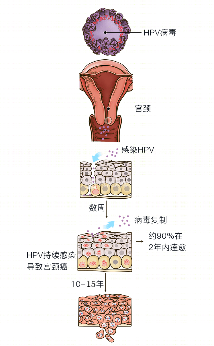 是由人乳头状瘤病毒(hpv)引起的约95%以上的宫颈癌根据世界卫生组织的