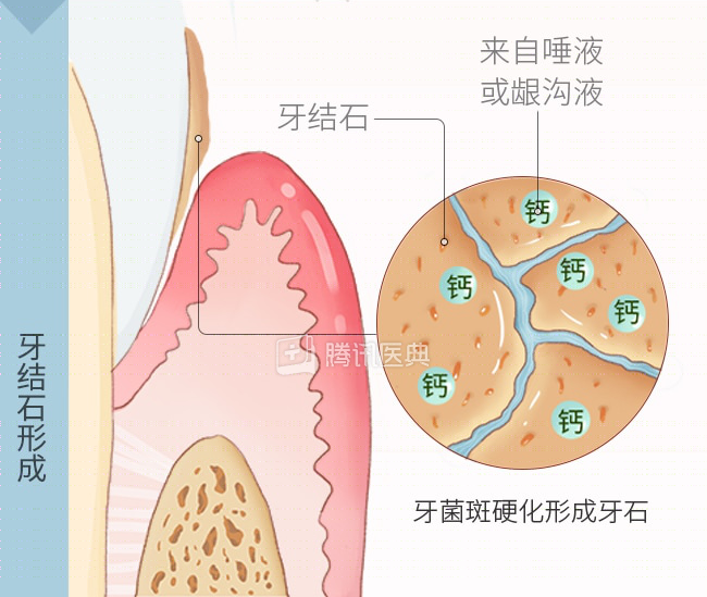 怎么选洁牙器械洗牙到底有好处还是坏处？牙医告诉你真相_https://www.jmylbn.com_新闻资讯_第3张