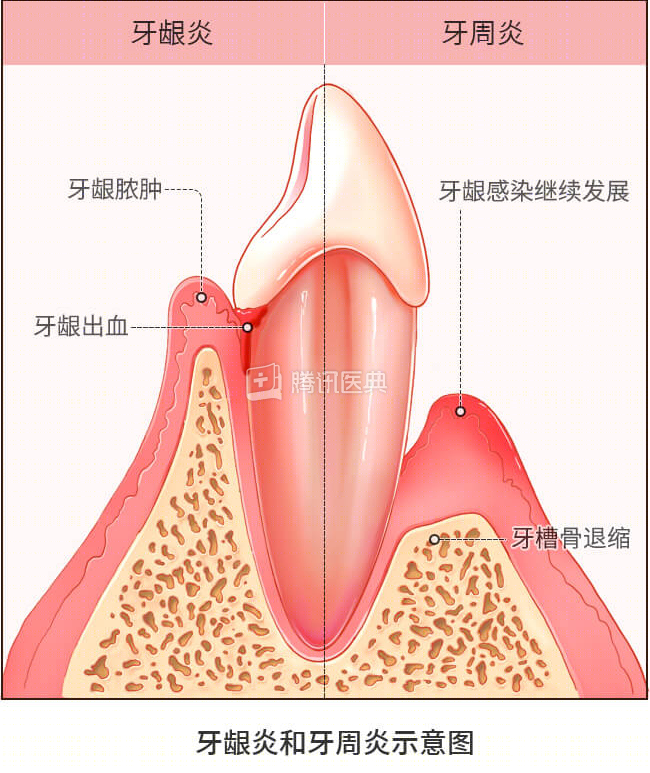 怎么选洁牙器械洗牙到底有好处还是坏处？牙医告诉你真相_https://www.jmylbn.com_新闻资讯_第5张