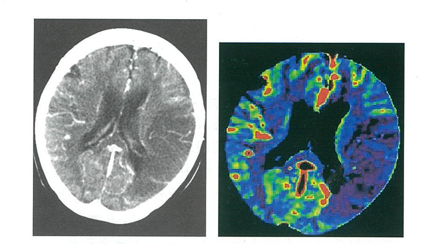急性缺血性腦卒中CT檢查重點須知！這套方案可救命！ 健康 第8張