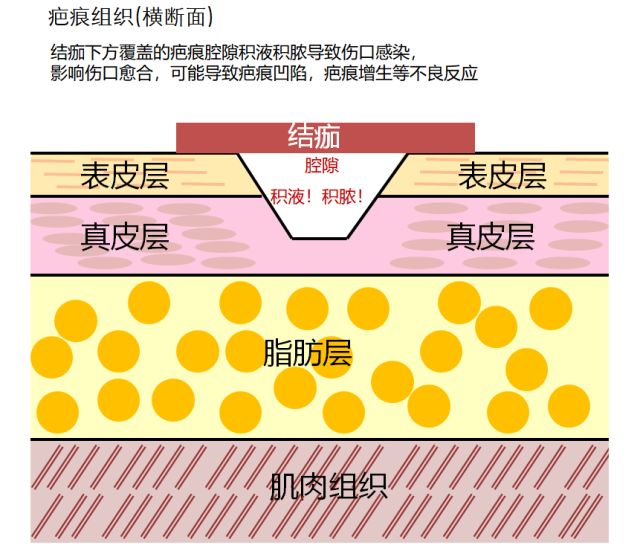 痂皮真的能保护伤口吗? 痂皮真的能保护伤口吗?
