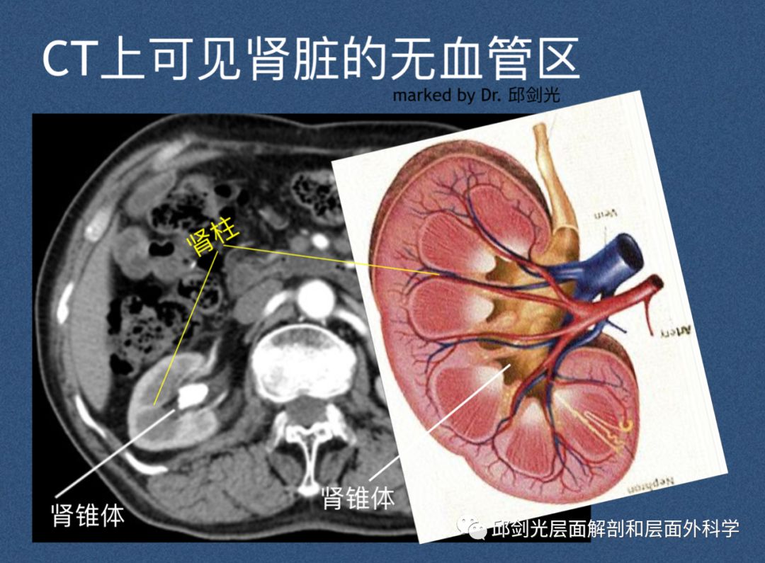 为什么pcnl术后的肾脏假性动脉瘤表现为每隔4到5天的反复出血 邱剑光层面解剖和层面外科学 微信公众号文章阅读 Wemp