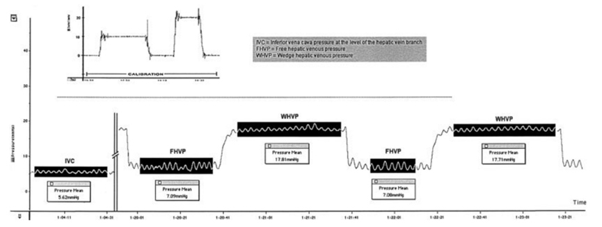 测胆道压力怎么测文献速递（第820期）— 肝静脉压力梯度：任何值得做的事情都应该做好_https://www.jmylbn.com_新闻资讯_第4张