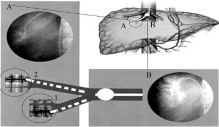 测胆道压力怎么测文献速递（第820期）— 肝静脉压力梯度：任何值得做的事情都应该做好_https://www.jmylbn.com_新闻资讯_第3张
