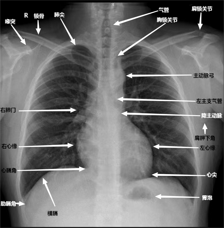 DR胶片为什么分尺寸借DR成像原理详解胸部正位摄片技术参数_https://www.jmylbn.com_新闻资讯_第3张