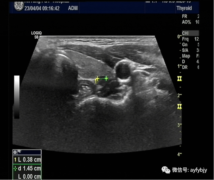 活检MM什么【一根细针辨良恶】一例超声引导下5mm×4mm甲状腺癌细针穿刺活检个案报道_https://www.jmylbn.com_新闻资讯_第5张