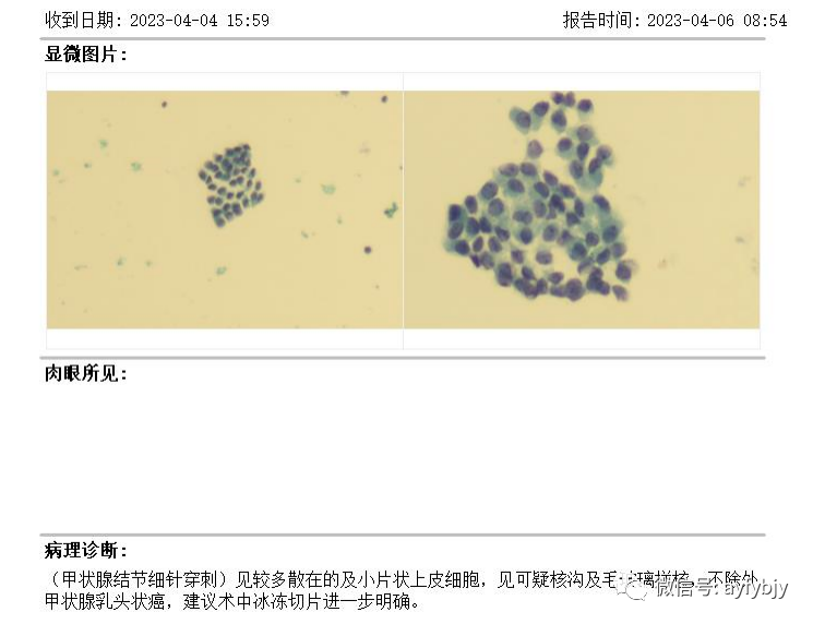 活检MM什么【一根细针辨良恶】一例超声引导下5mm×4mm甲状腺癌细针穿刺活检个案报道_https://www.jmylbn.com_新闻资讯_第8张