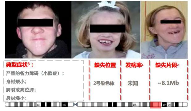 cri-du-chat综合征(猫叫综合征)5.angelman综合征(天使综合征)6.