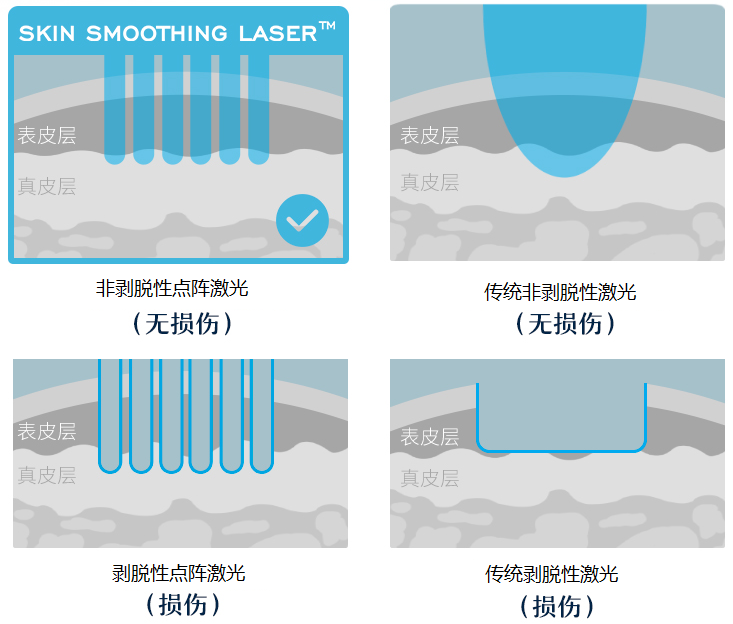 二氧化碳(co2)激光治疗是什么二氧化碳（CO₂）点阵激光，除了治疗痘坑还有哪些功能？_https://www.jmylbn.com_新闻资讯_第6张
