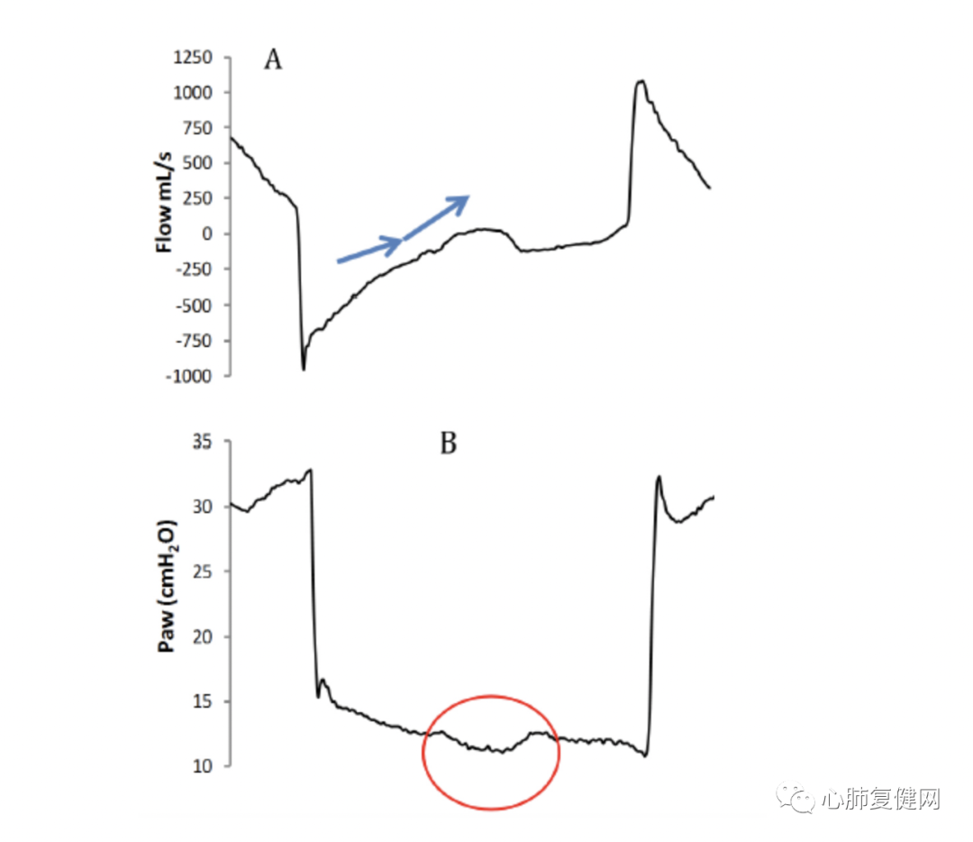 为什么呼吸机人机同步如何提高患者与呼吸机的同步性——第一部分_https://www.jmylbn.com_新闻资讯_第3张
