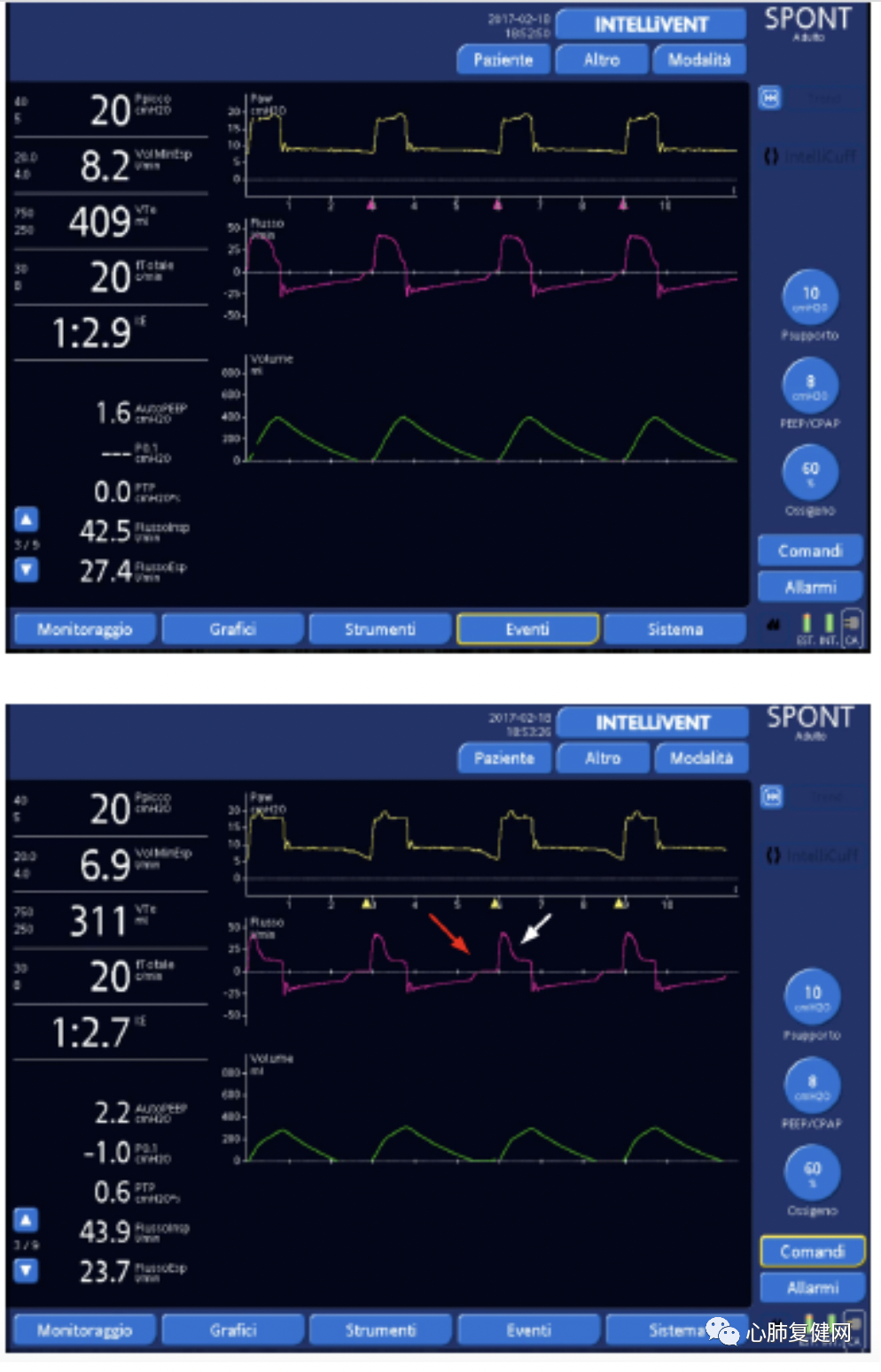 为什么呼吸机人机同步如何提高患者与呼吸机的同步性——第一部分_https://www.jmylbn.com_新闻资讯_第6张
