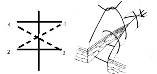 医疗缝线怎么做【临床分享】外科缝合操作，你做对了吗？_https://www.jmylbn.com_新闻资讯_第6张