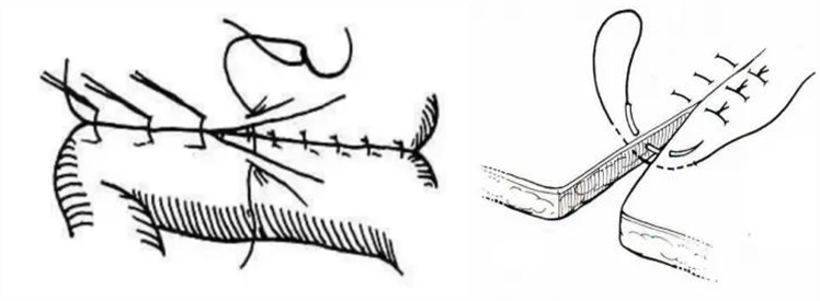 医疗缝线怎么做【临床分享】外科缝合操作，你做对了吗？_https://www.jmylbn.com_新闻资讯_第8张