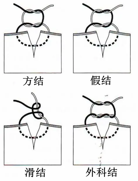 医疗缝线怎么做【临床分享】外科缝合操作，你做对了吗？_https://www.jmylbn.com_新闻资讯_第14张