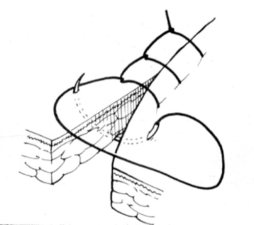 医疗缝线怎么做【临床分享】外科缝合操作，你做对了吗？_https://www.jmylbn.com_新闻资讯_第5张