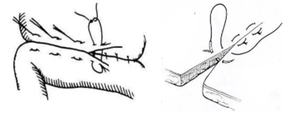 医疗缝线怎么做【临床分享】外科缝合操作，你做对了吗？_https://www.jmylbn.com_新闻资讯_第9张