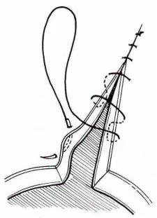 医疗缝线怎么做【临床分享】外科缝合操作，你做对了吗？_https://www.jmylbn.com_新闻资讯_第10张