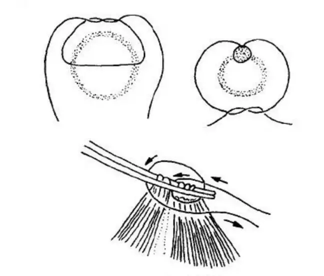 医疗缝线怎么做【临床分享】外科缝合操作，你做对了吗？_https://www.jmylbn.com_新闻资讯_第7张