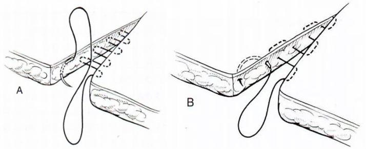 医疗缝线怎么做【临床分享】外科缝合操作，你做对了吗？_https://www.jmylbn.com_新闻资讯_第13张