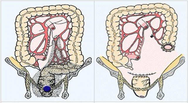 apr手术和hartmann手术对于早期结直肠癌,不用切除大段肠管和组织