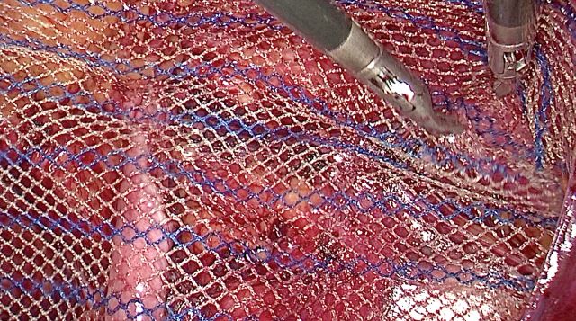 疝气补片怎么固定外科手术中用的疝补片，你了解多少？_https://www.jmylbn.com_新闻资讯_第3张