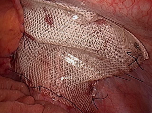 疝气补片怎么固定外科手术中用的疝补片，你了解多少？_https://www.jmylbn.com_新闻资讯_第4张
