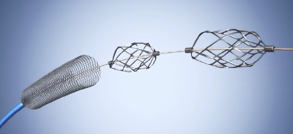 什么是外周支架获批FDA！最大号外周动脉取栓支架_https://www.jmylbn.com_新闻资讯_第4张