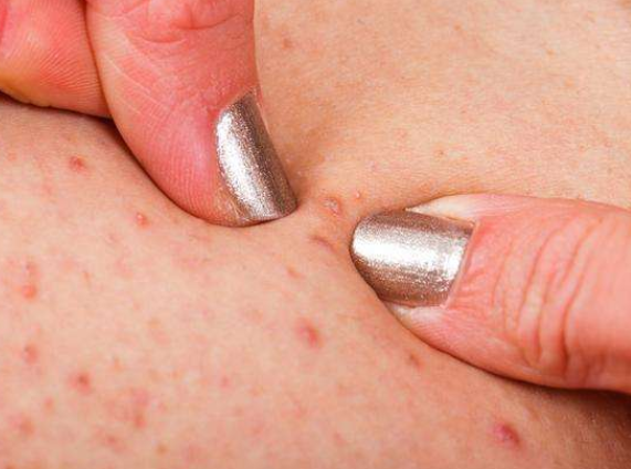 许多人忽视的毛囊炎，是怎么长成瘢痕疙瘩的？