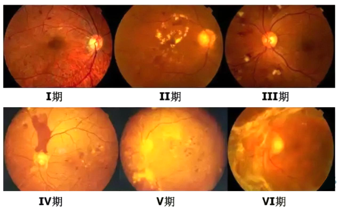 眼科手术新高度济宁市第二人民医院眼科再次成功实施复杂玻璃体视网膜